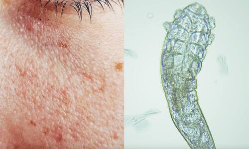 Podrías estarlo confundiendo con el acné (Foto: Twitter)