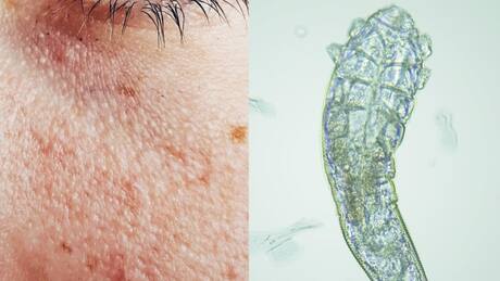 ¿Tienes puntitos blancos en la cara? No es acné, podría ser un parásito