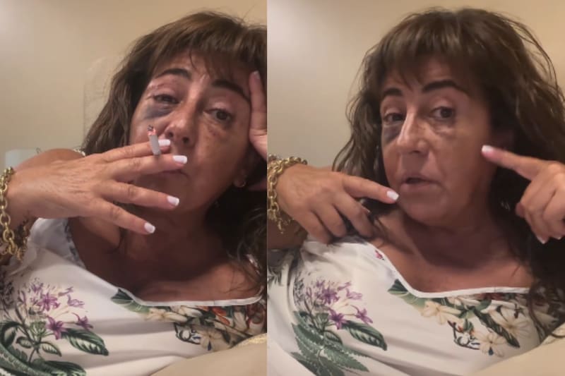 habla sobre el avance de su intervención estética y menciona que se realizará otra en un futuro.