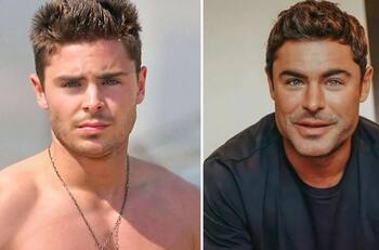 Así lucía Zac Efron antes y después del accidente que casi le quita la vida