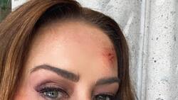 Anette Michel aparece en redes ¡con el rostro golpeado!