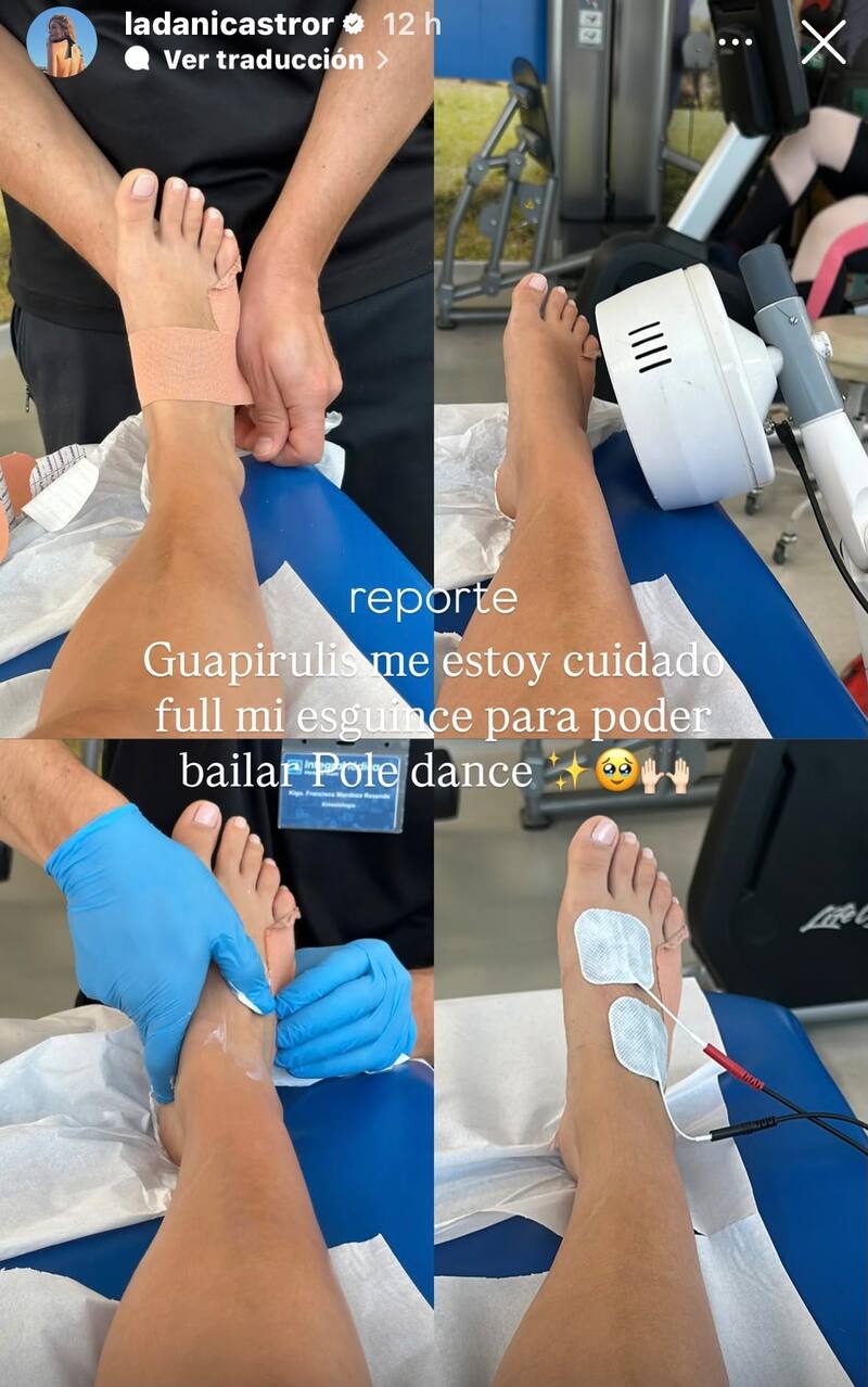 La influencer reveló que sufrió un terrible esguince.