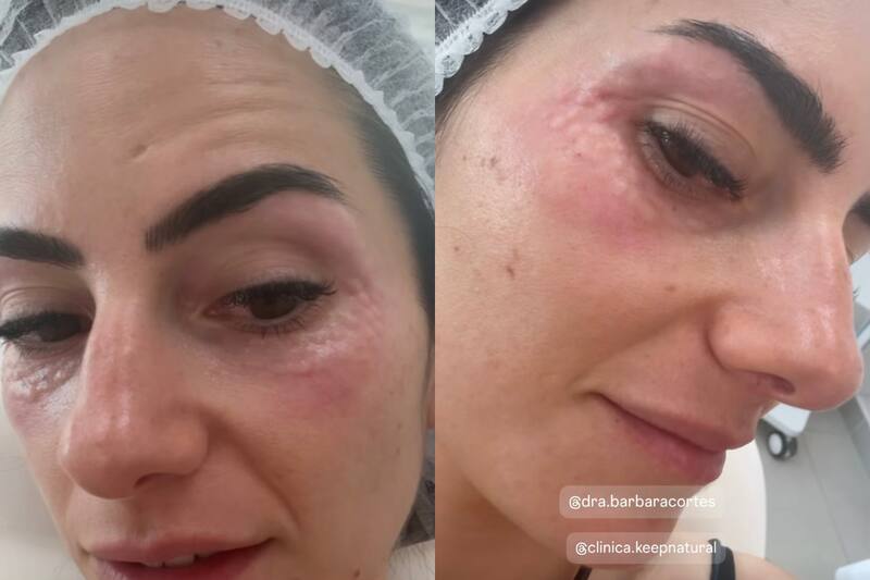 La influencer se sometió a procedimiento estético.