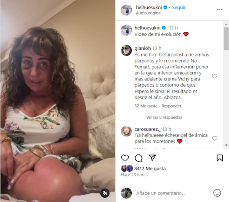 Helhue Sukni comenta sobre el avance de su intervención estetica.