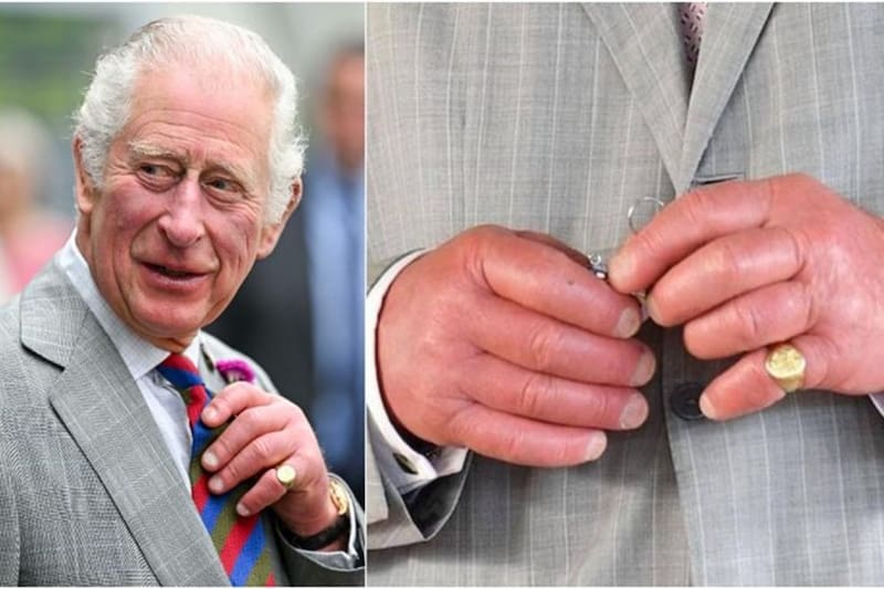 Realeza El rey Carlos III de Inglaterra sufre dactilitis, una enfermedad conocida coloquialmente como "dedos de salchicha". - Créditos: Instagram