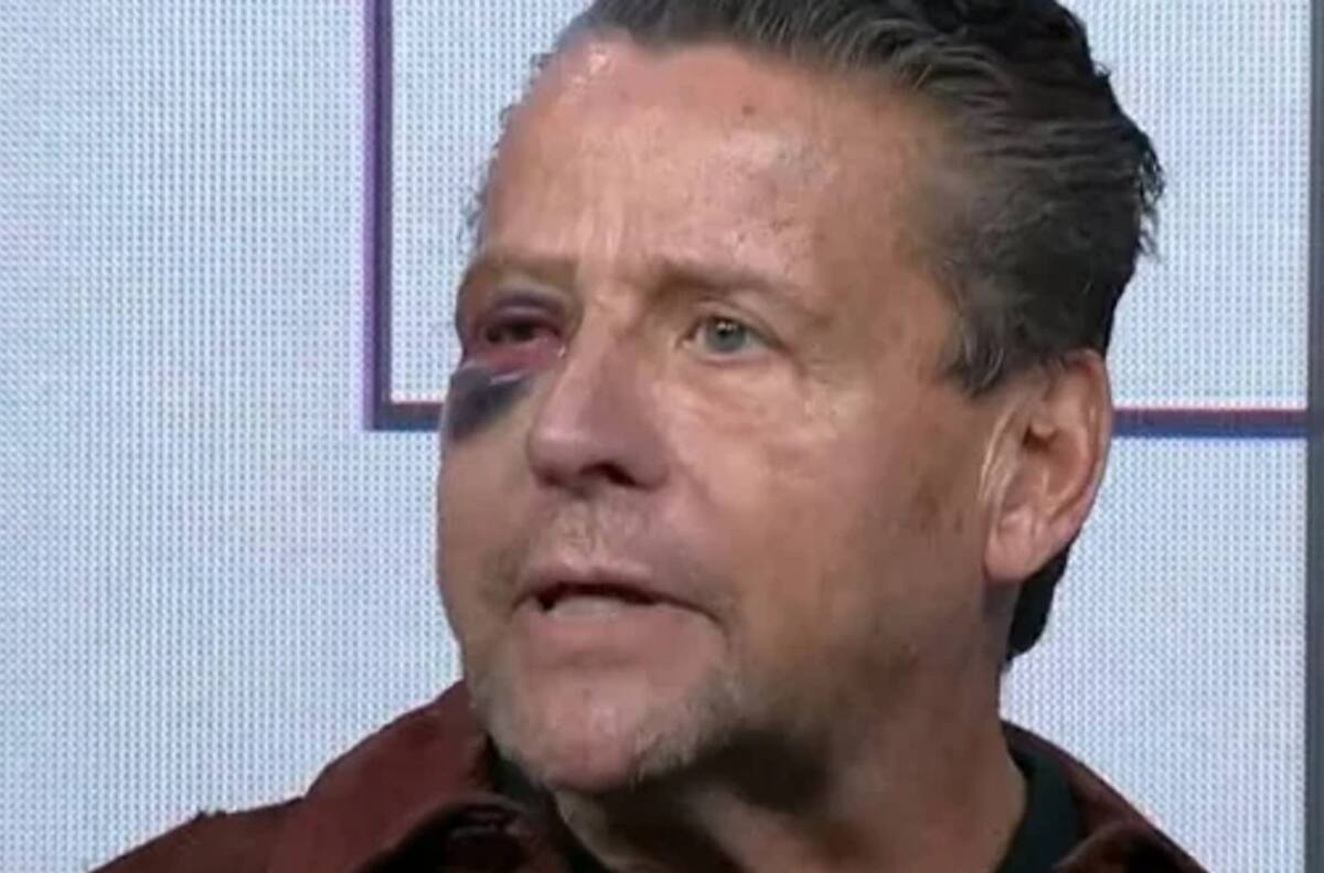 FOTOS: Alfredo Adame muestra cómo quedó su rostro tras cirugía y le llueven críticas