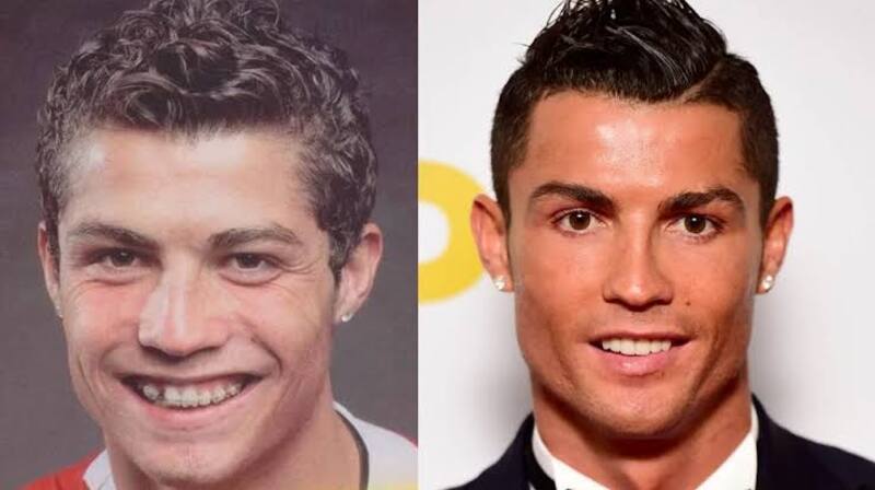 El antes y el después de su rinoplastía.