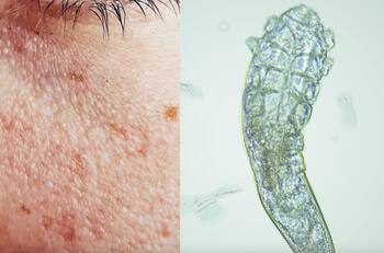 ¿Tienes puntitos blancos en la cara? No es acné, podría ser un parásito