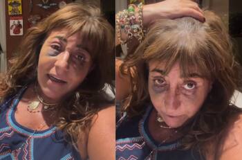 “Estoy un poco mejor”: Helhue Sukni actualiza su estado de salud tras intervención estética