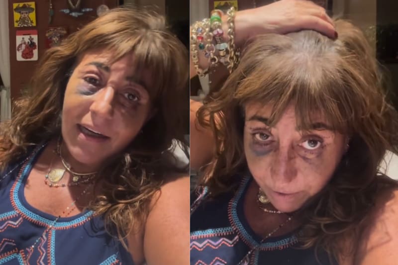 comentó el percance que tuvo tras intervención estética.