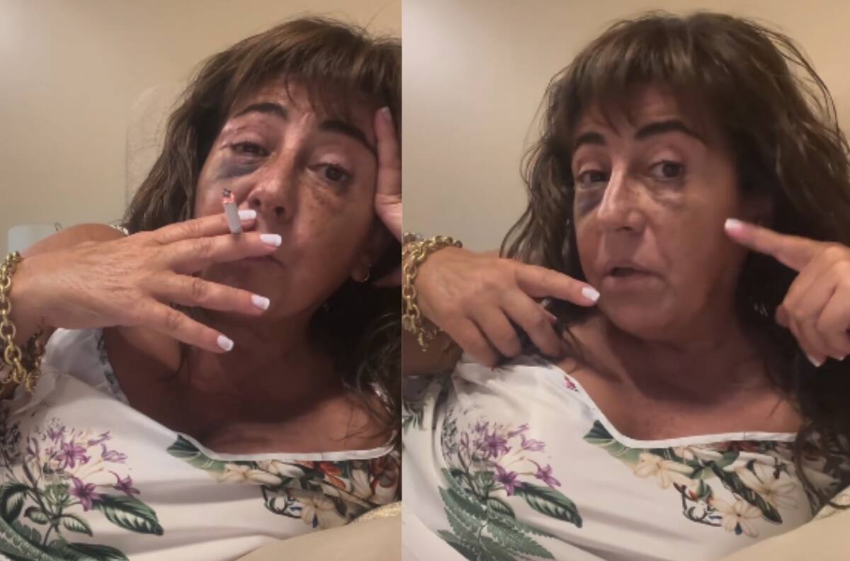 “Voy a quedar joven”: Helhue Sukni habla tras su operación estética