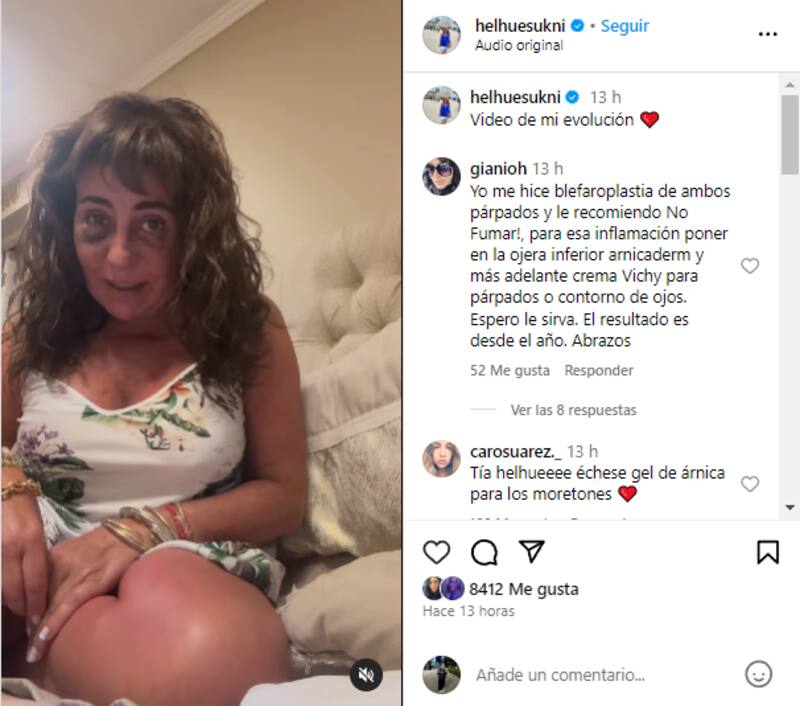 Helhue Sukni comenta sobre el avance de su intervención estetica.