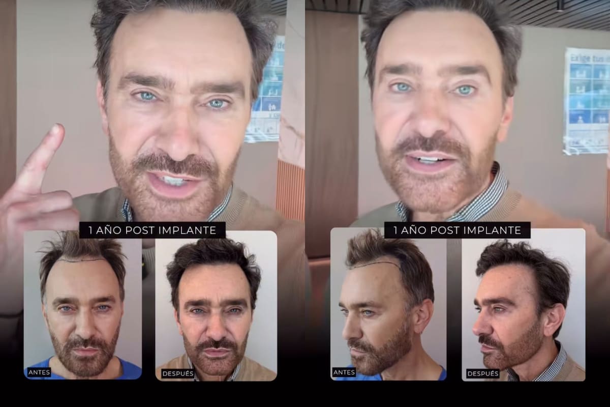 El resultado de su implante de cabello. Crédito: IG: Clínica Lo Arcaya