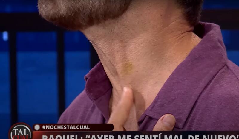 Jordi Castell muestra su nuevo cuello tras procedimiento estético.