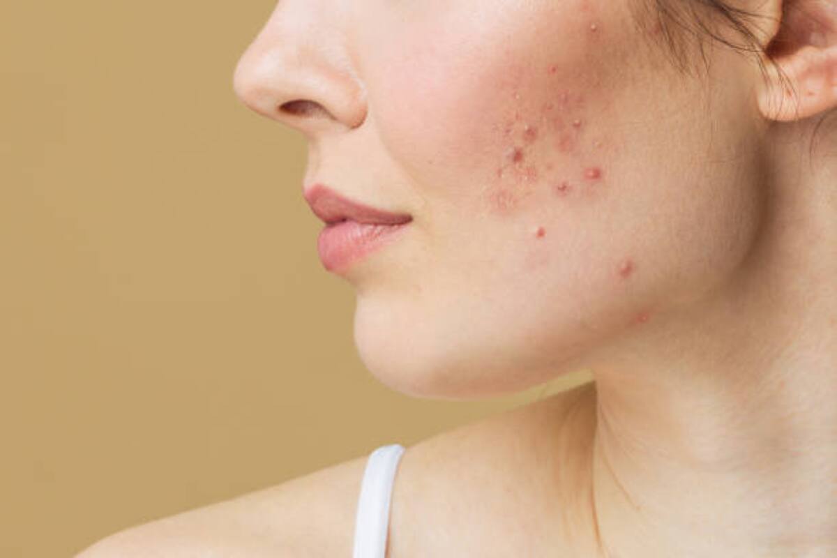 Es común confundir el acné con demodex