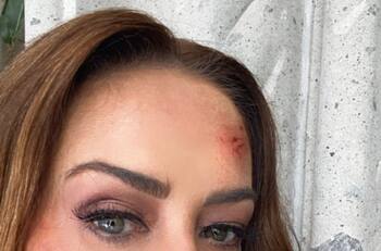Anette Michel aparece en redes ¡con el rostro golpeado!